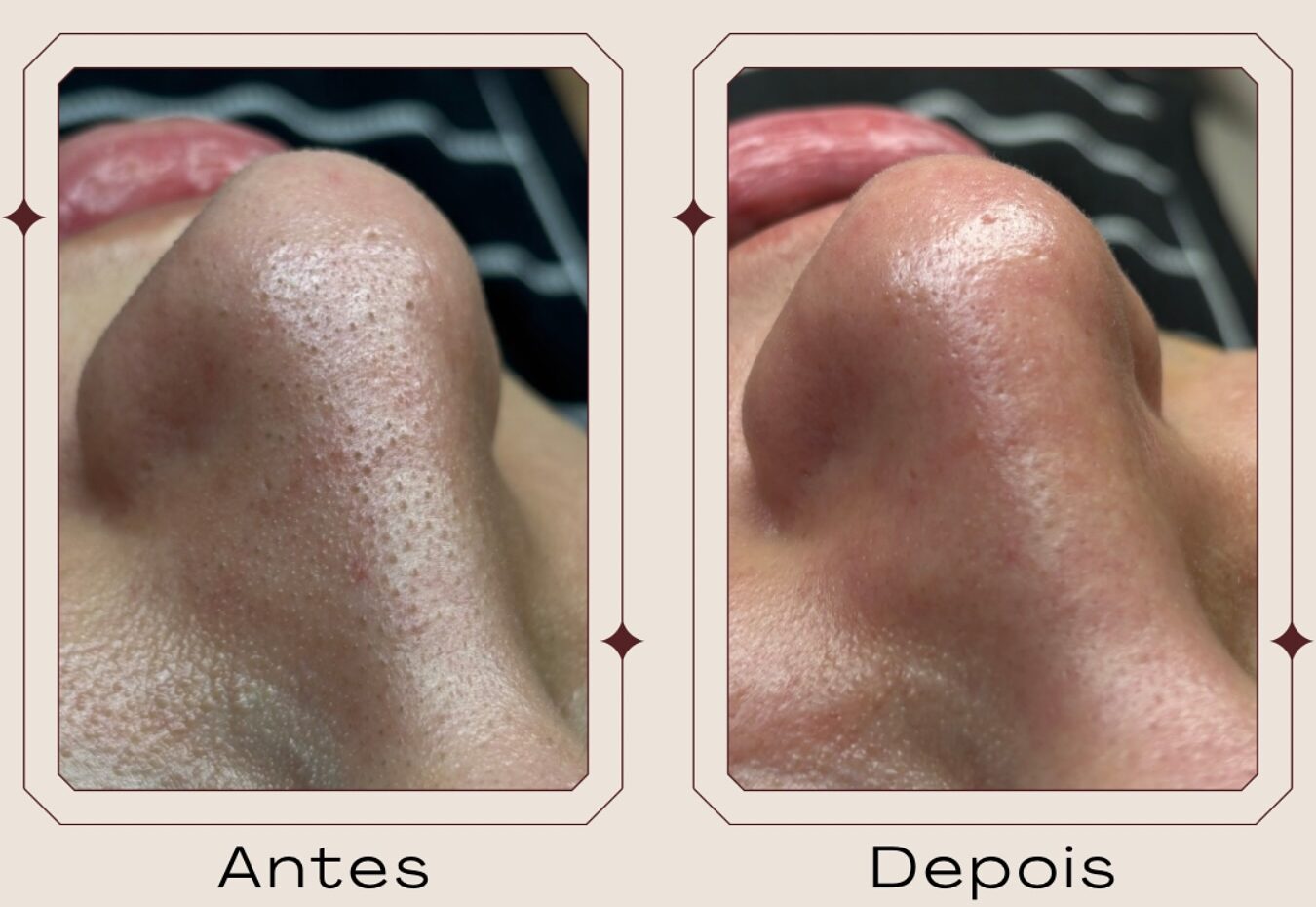 Limpeza de Pele Premium no Centro de São José dos Pinhais - PR | Marafigo Clínica Integrativa Clínica