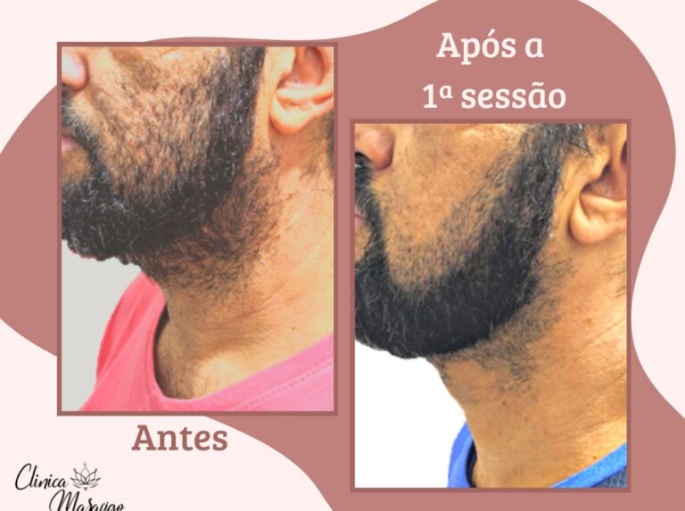 Antes e depois · Marafigo Clínica Integrativa — clinica de estetica em Centro, São José dos Pinhais - PR