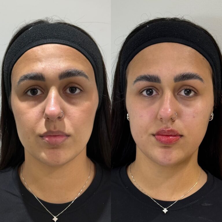 Antes e depois · Marafigo Clínica Integrativa — clinica de estetica em Centro, São José dos Pinhais - PR