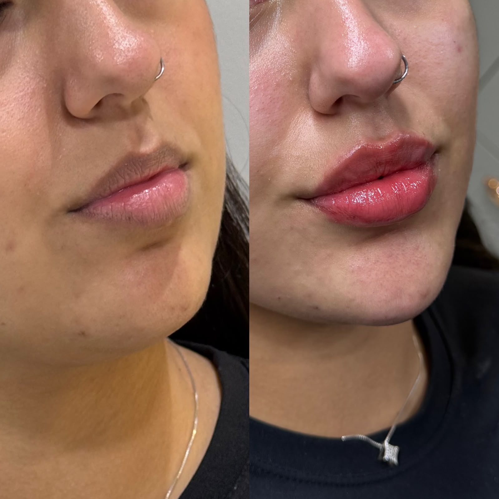 Preenchimento labial · Marafigo Clínica Integrativa