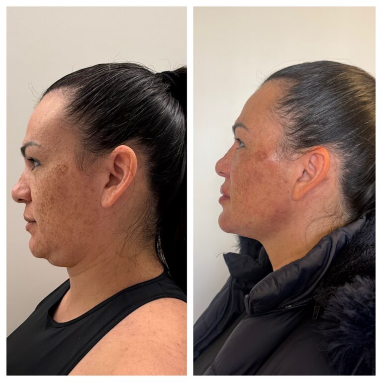 Tratamento de Melasma no Centro de São José dos Pinhais - PR | Marafigo Clínica Integrativa Clínica de Estética