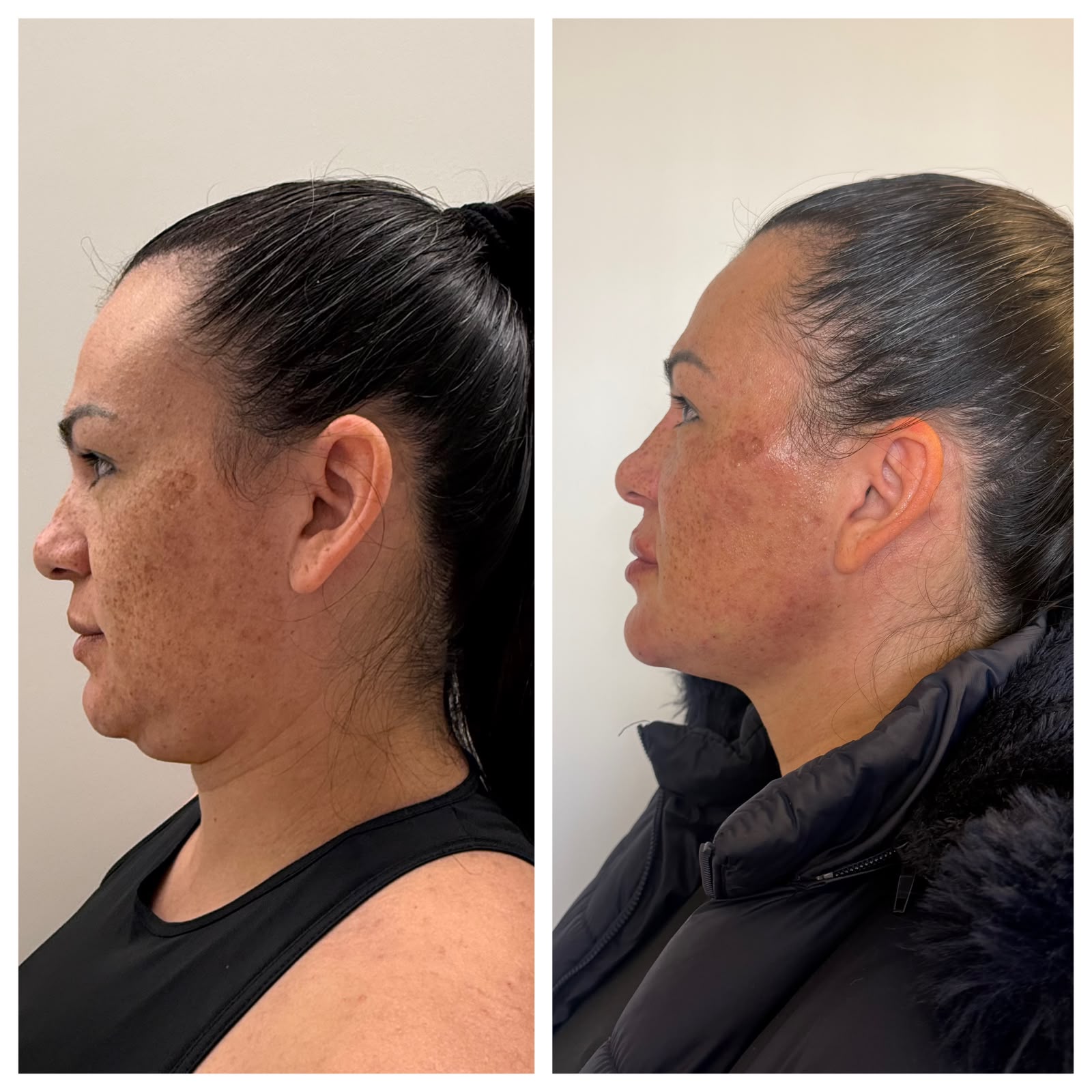 Tratamento de Melasma no Centro de São José dos Pinhais - PR | Marafigo Clínica Integrativa Clínica de Estética