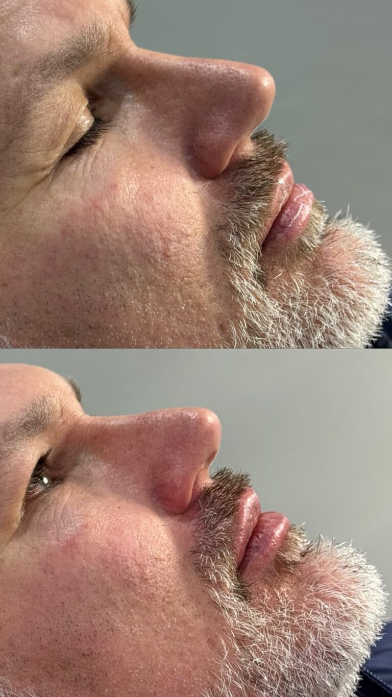 Antes e depois · Marafigo Clínica Integrativa — clinica de estetica em Centro, São José dos Pinhais - PR