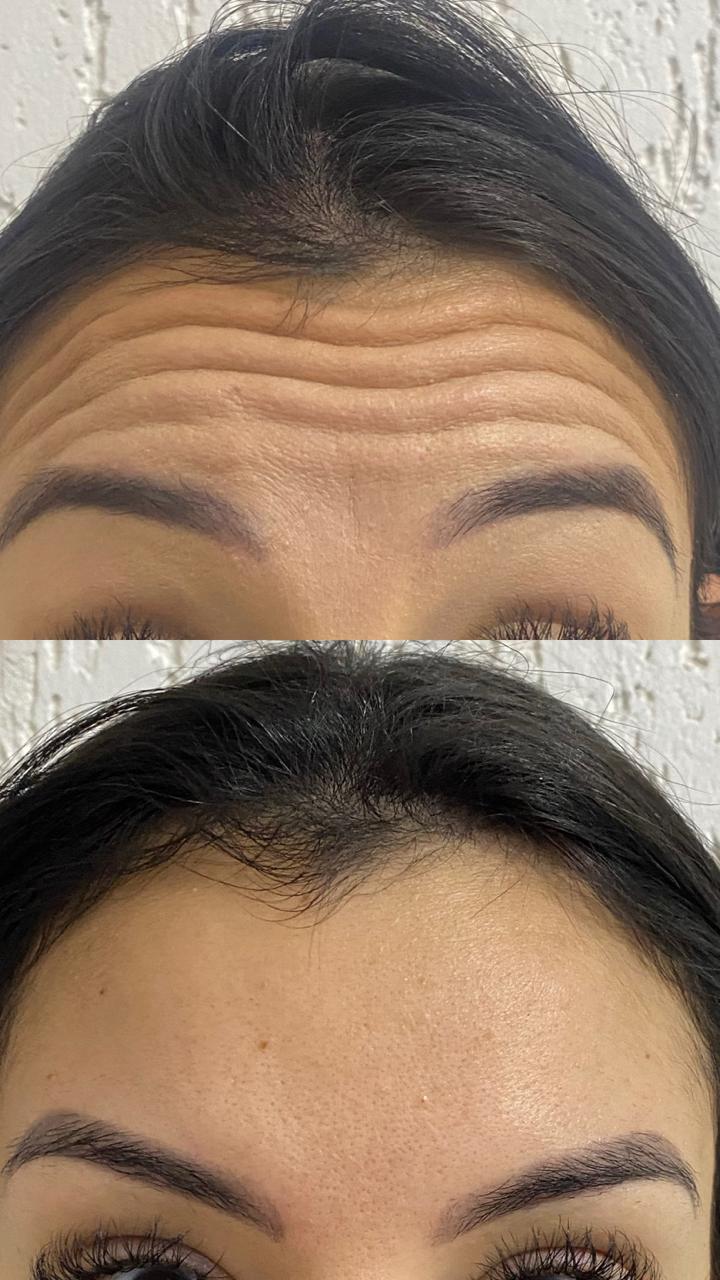 Antes e depois · Marafigo Clínica Integrativa — clinica de estetica em Centro, São José dos Pinhais - PR