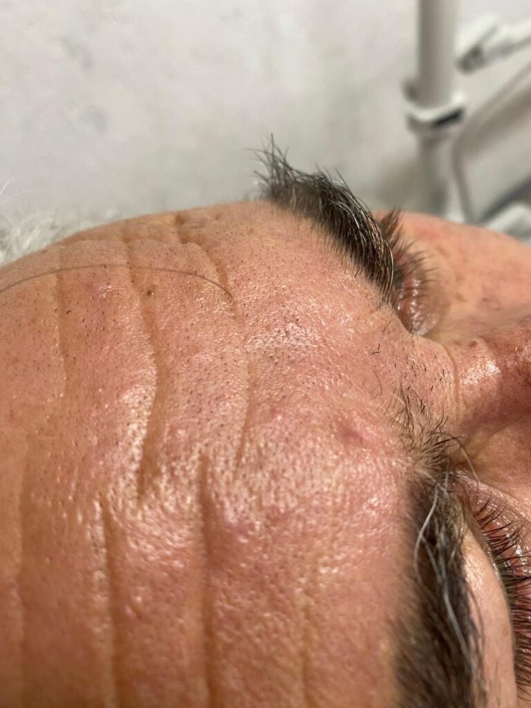 Retirada de Verrugas com Jato de Plasma no Centro de São José dos Pinhais - PR | Marafigo Clínica Integrativa